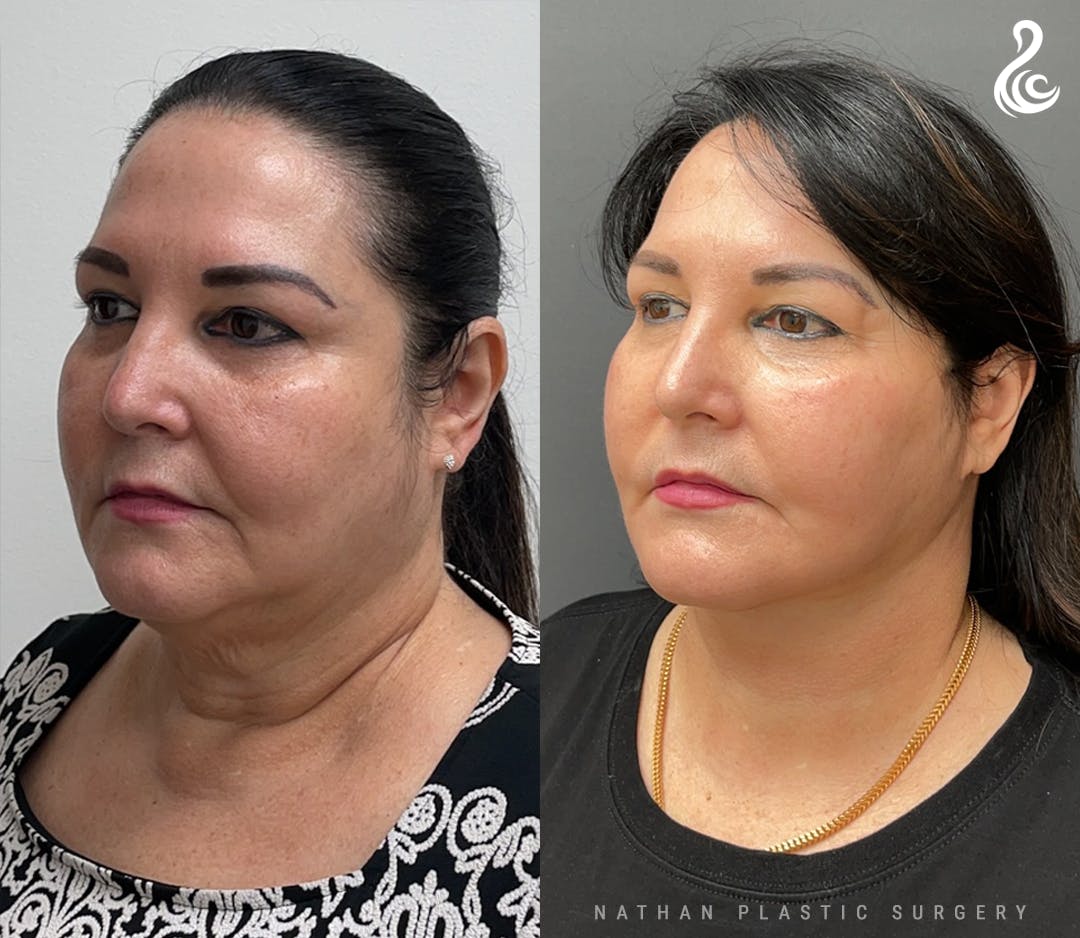 Facelift Before & After Gallery - Patient 170380 - Image 2