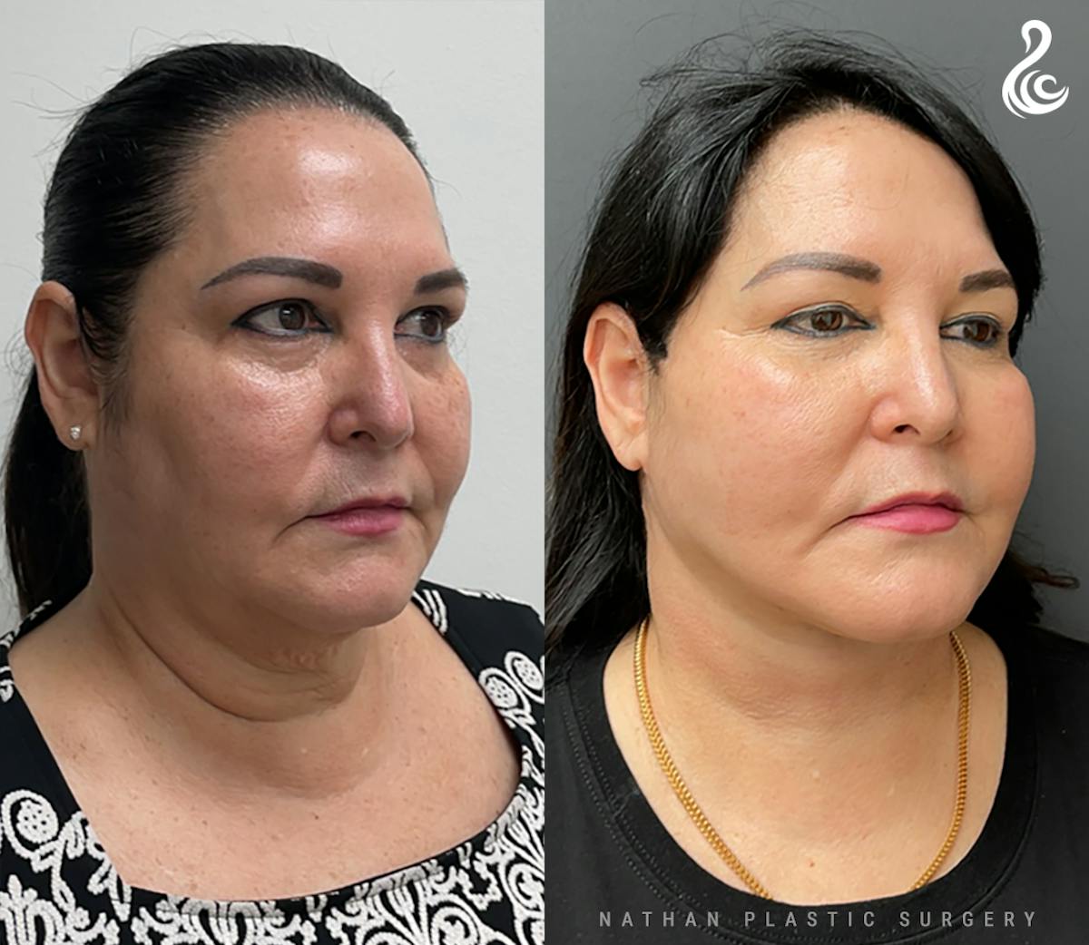 Facelift Before & After Gallery - Patient 170380 - Image 3