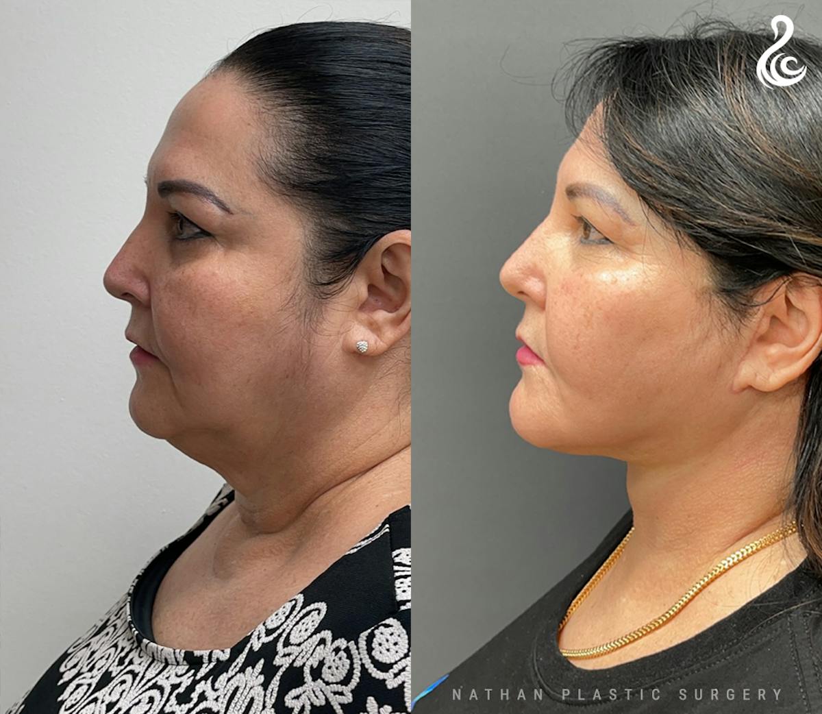 Facelift Before & After Gallery - Patient 170380 - Image 4