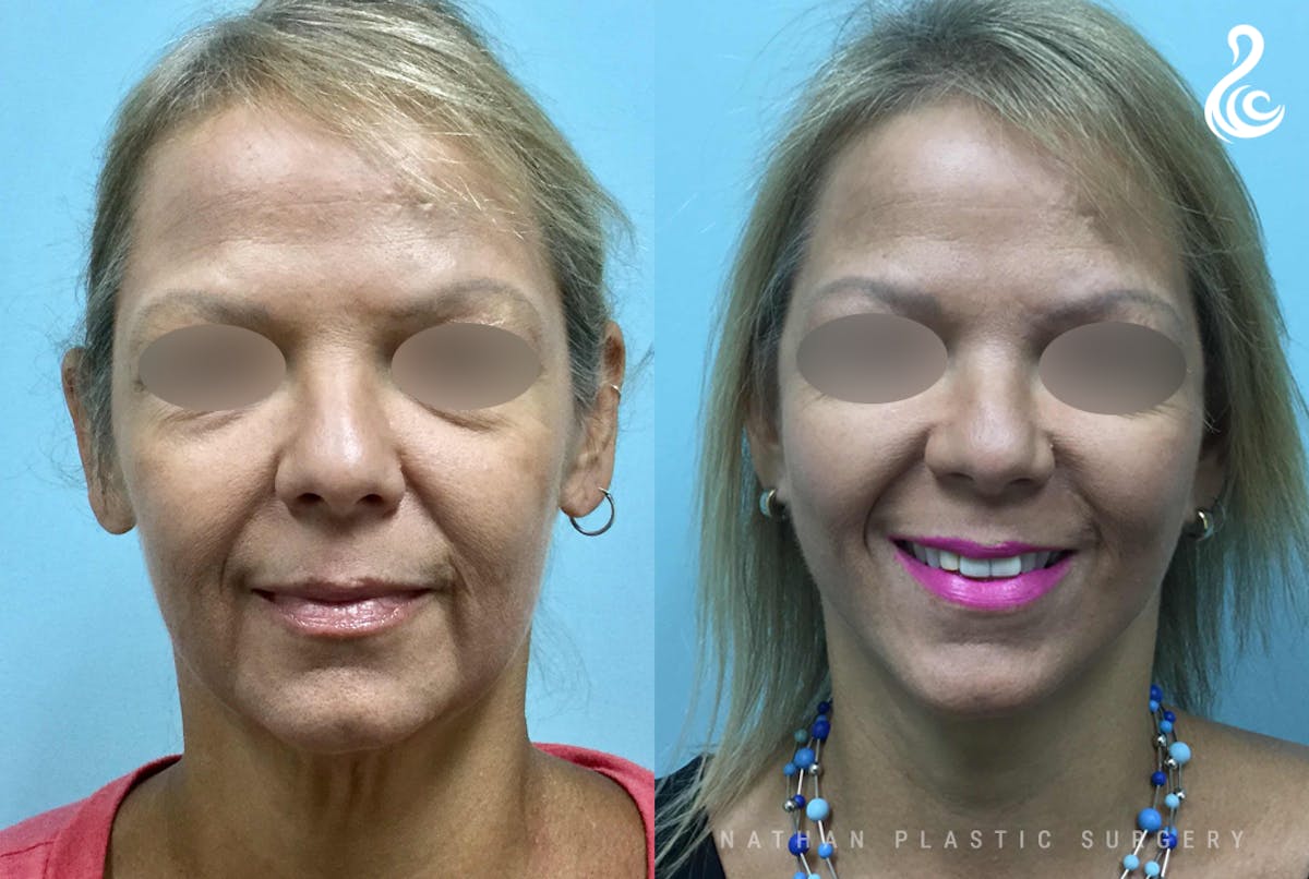 Facelift Before & After Gallery - Patient 632636 - Image 1