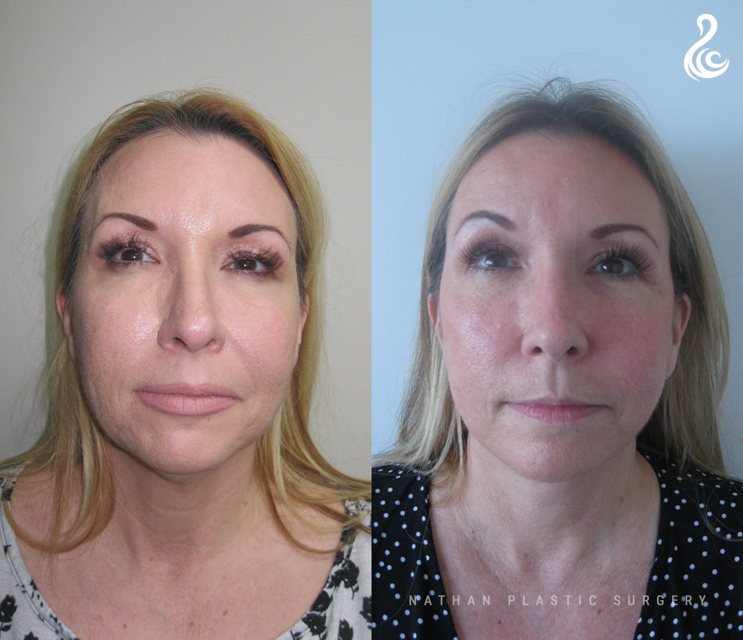 Facelift Before & After Gallery - Patient 427920 - Image 1