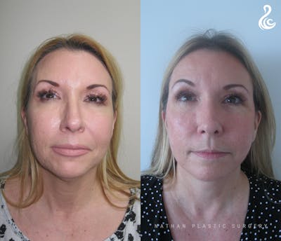 Facelift Before & After Gallery - Patient 427920 - Image 1