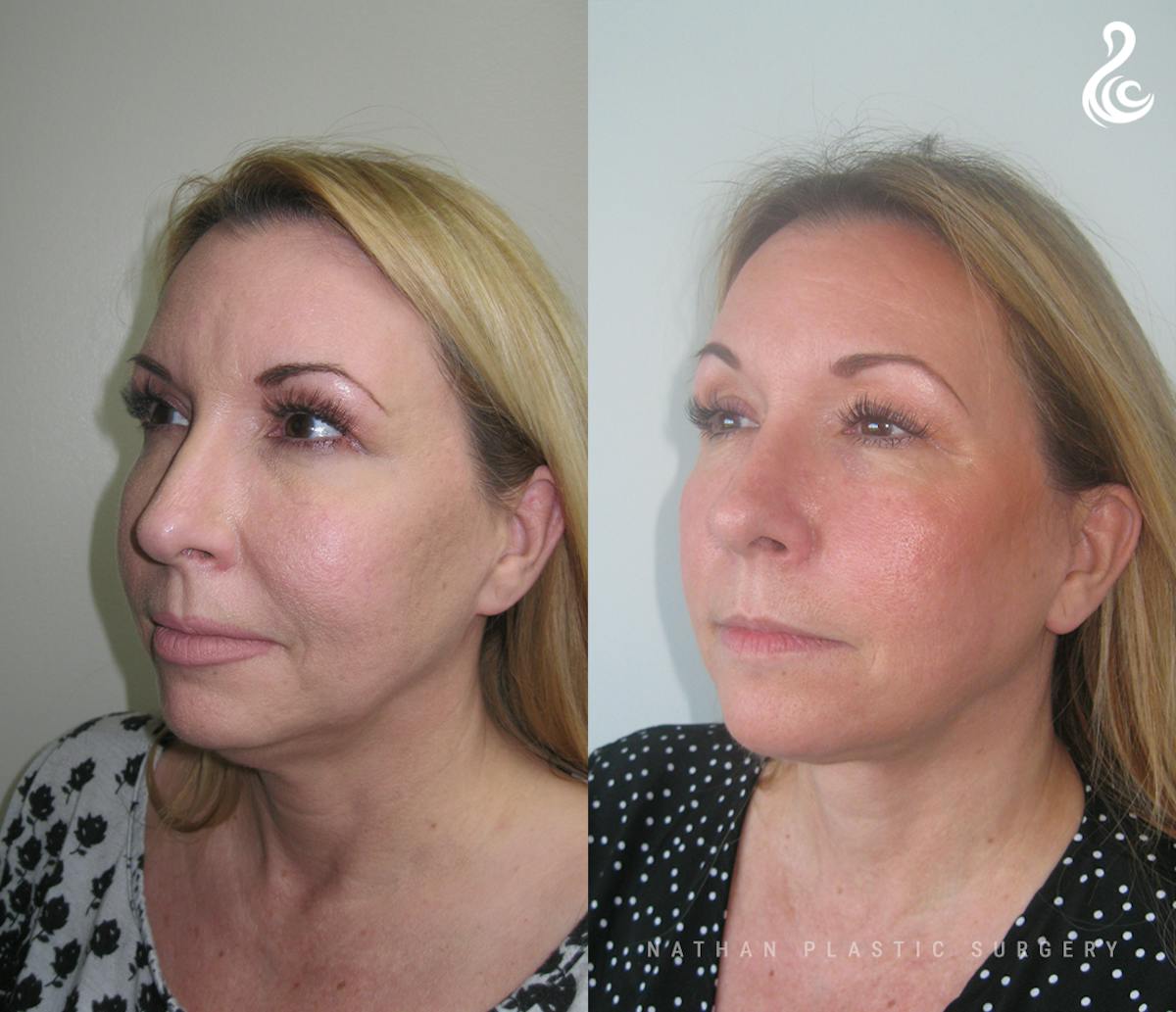 Facelift Before & After Gallery - Patient 427920 - Image 2