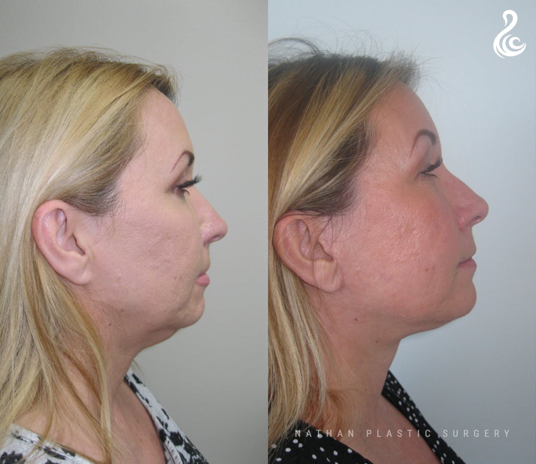 Facelift Before & After Gallery - Patient 427920 - Image 3