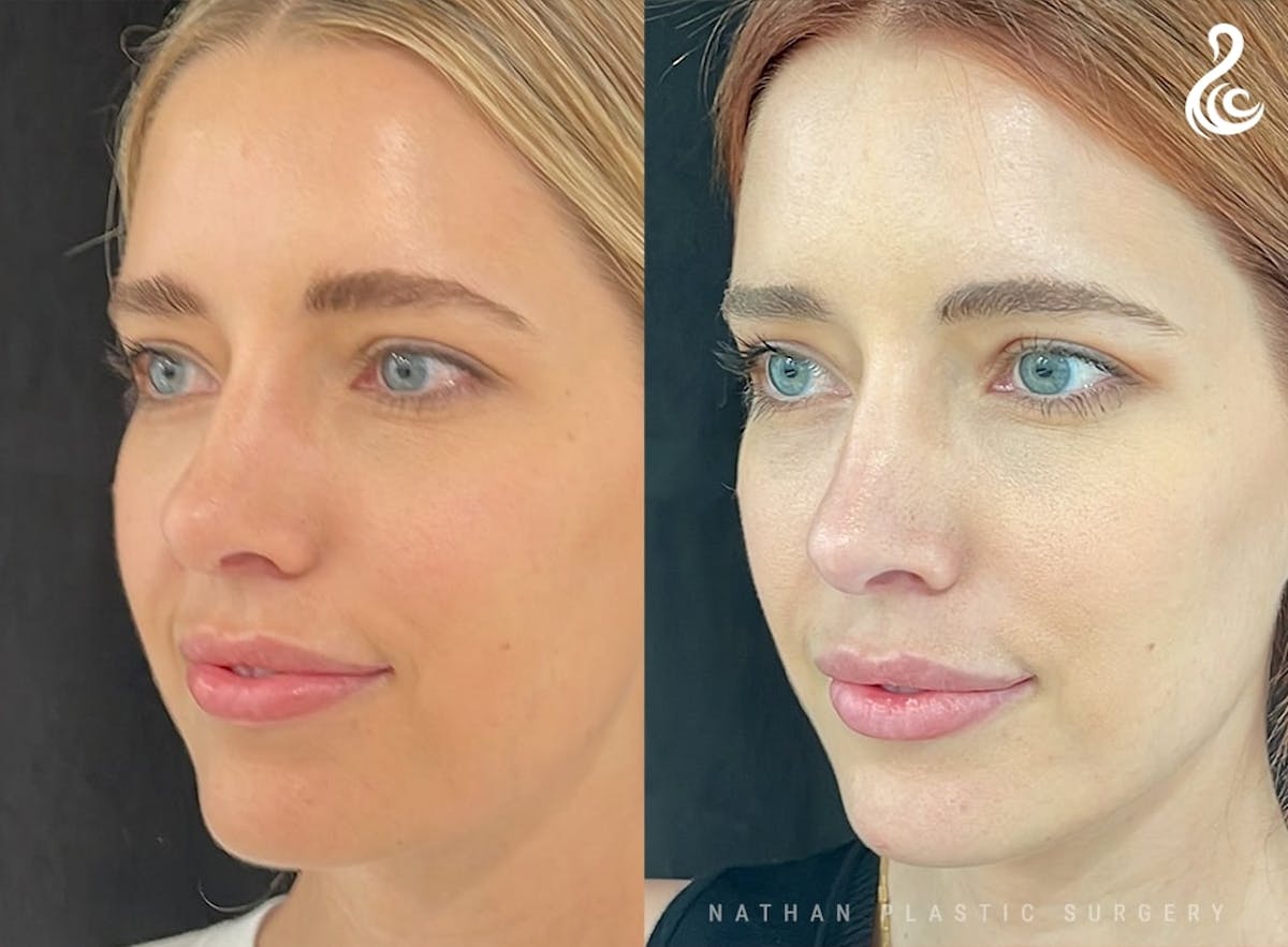 Rhinoplasty Before & After Gallery - Patient 103335 - Image 4