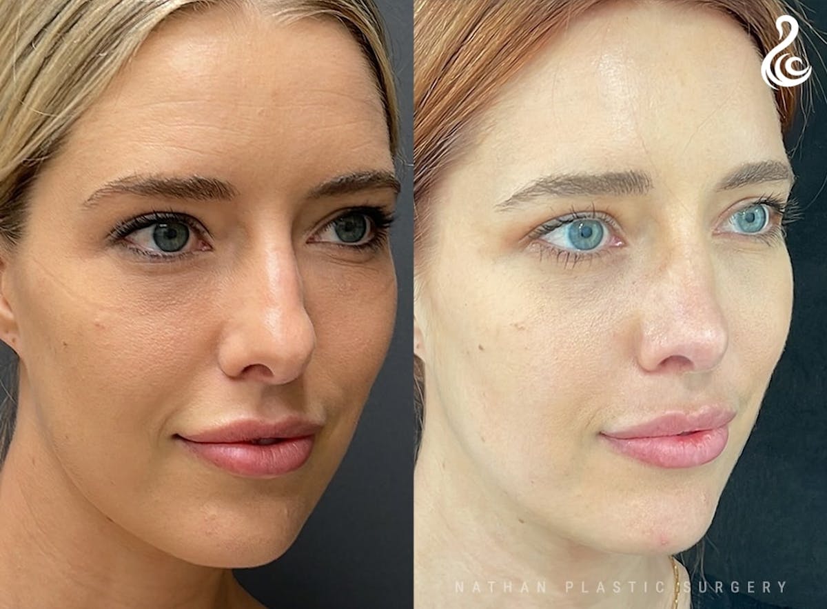 Rhinoplasty Before & After Gallery - Patient 103335 - Image 5