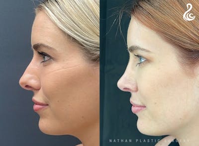 Rhinoplasty Before & After Gallery - Patient 103335 - Image 1