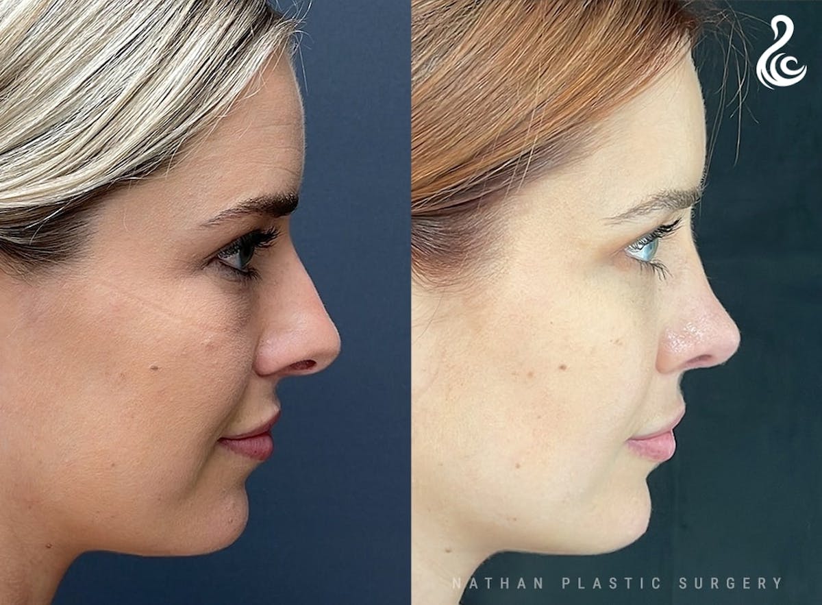 Rhinoplasty Before & After Gallery - Patient 103335 - Image 2