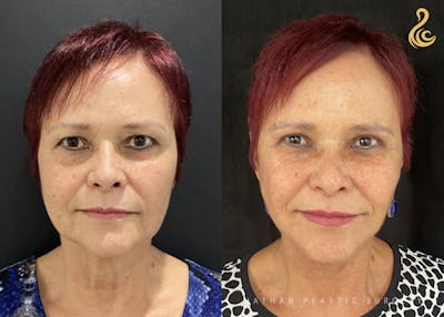 Facelift Before & After Gallery - Patient 726367 - Image 1
