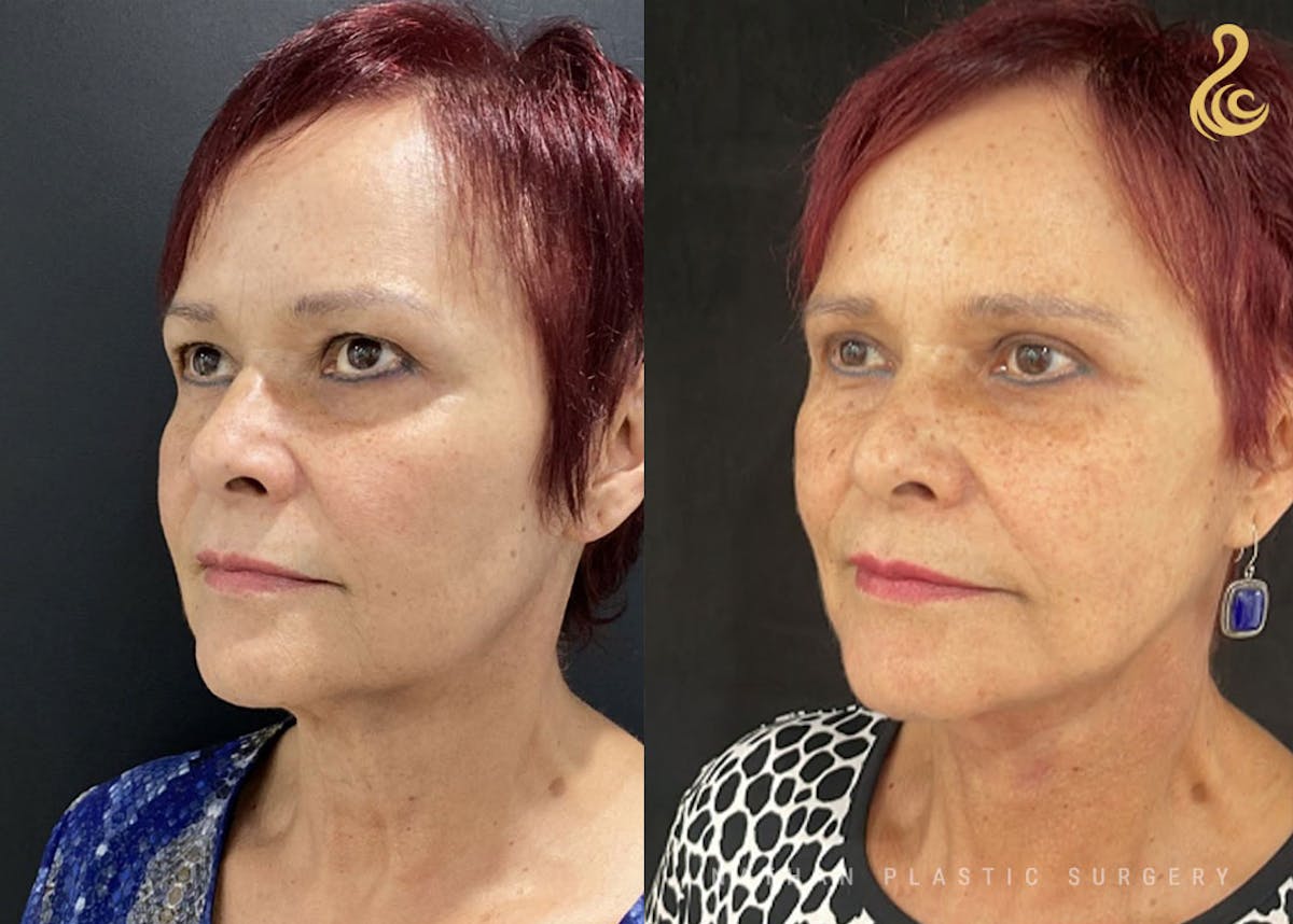 Facelift Before & After Gallery - Patient 726367 - Image 2