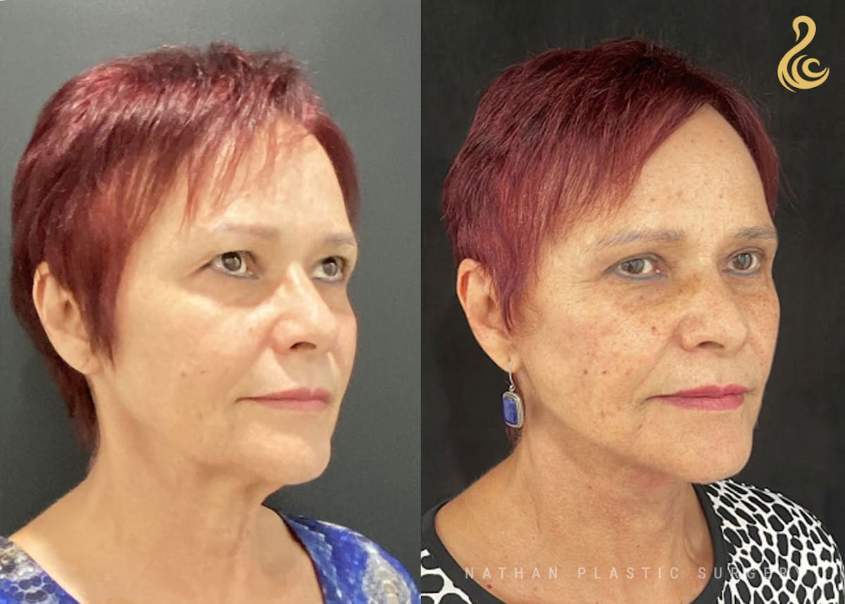Facelift Before & After Gallery - Patient 726367 - Image 3