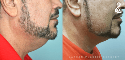 Neck Lift Before & After Gallery - Patient 395797 - Image 1