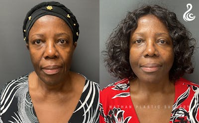Facelift Before & After Gallery - Patient 297114 - Image 1