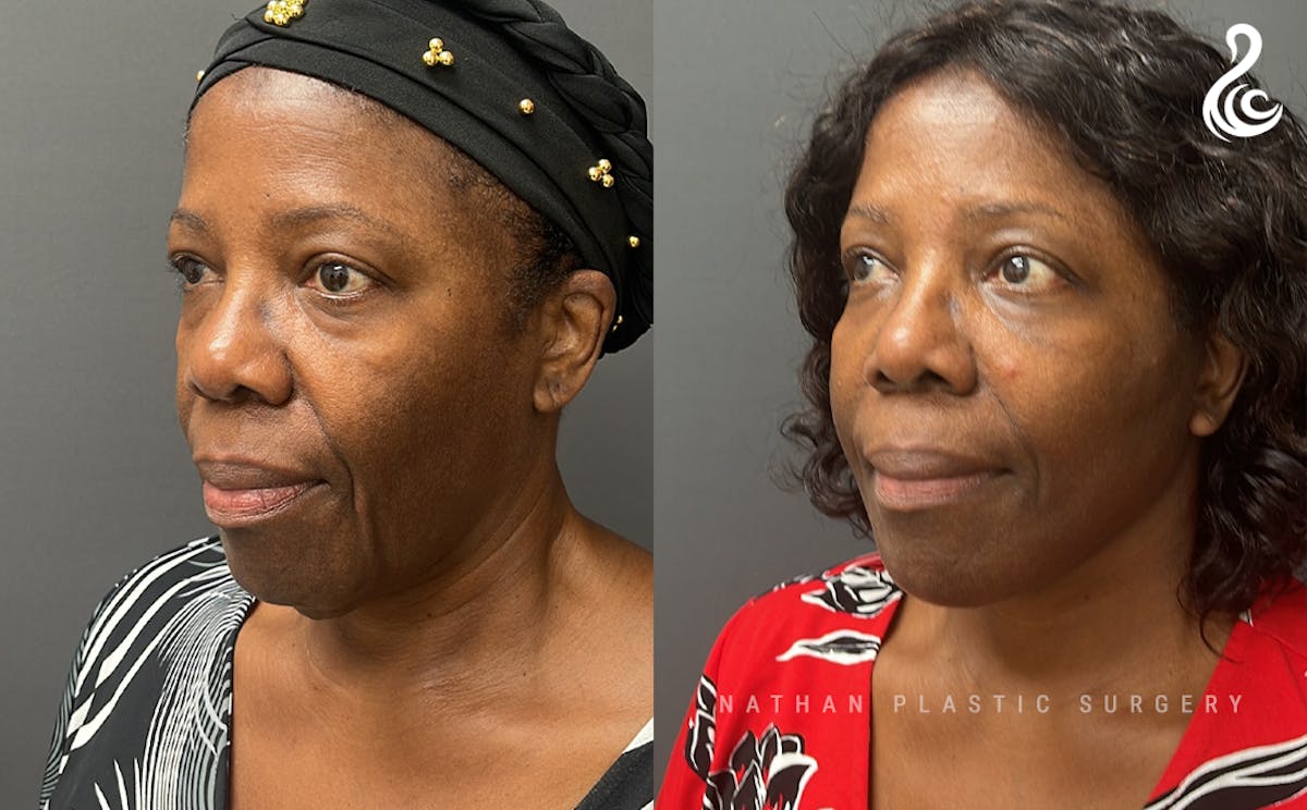 Neck Lift Before & After Gallery - Patient 211014 - Image 3