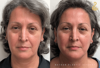 Facelift Before & After Gallery - Patient 313780 - Image 1