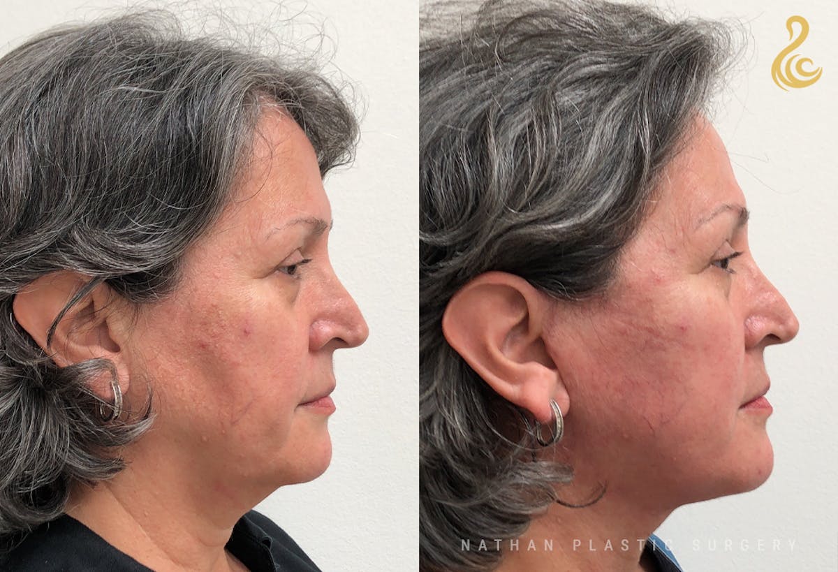 Facelift Before & After Gallery - Patient 313780 - Image 3