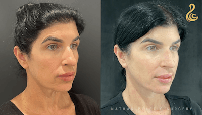 Facelift Before & After Gallery - Patient 312876 - Image 1