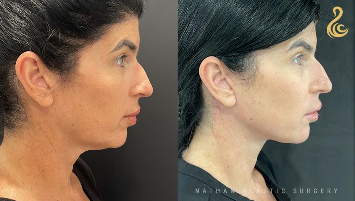 Facelift Before & After Gallery - Patient 312876 - Image 2