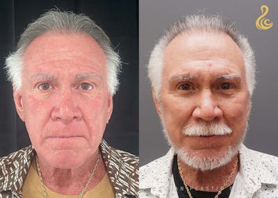 Facelift Before & After Gallery - Patient 192586 - Image 1