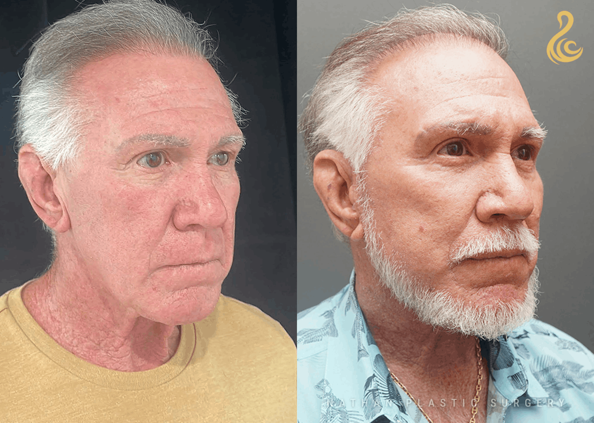 Facelift Before & After Gallery - Patient 192586 - Image 2
