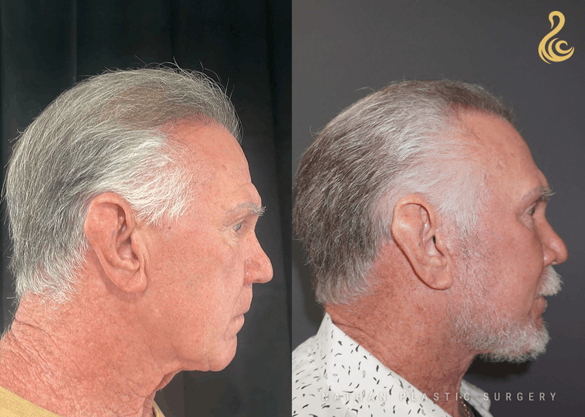 Facelift Before & After Gallery - Patient 192586 - Image 3