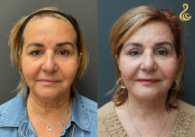 Facelift Before & After Gallery - Patient 127560 - Image 1