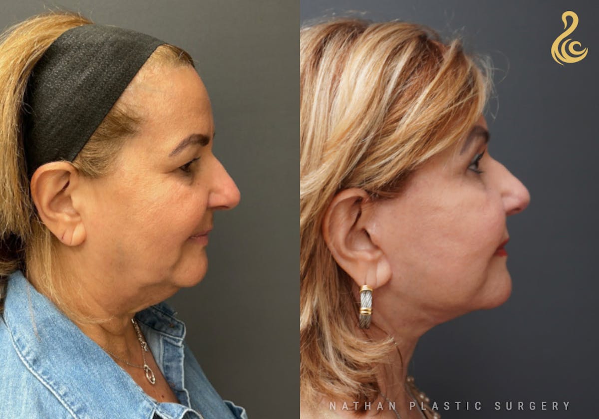 Facelift Before & After Gallery - Patient 127560 - Image 3