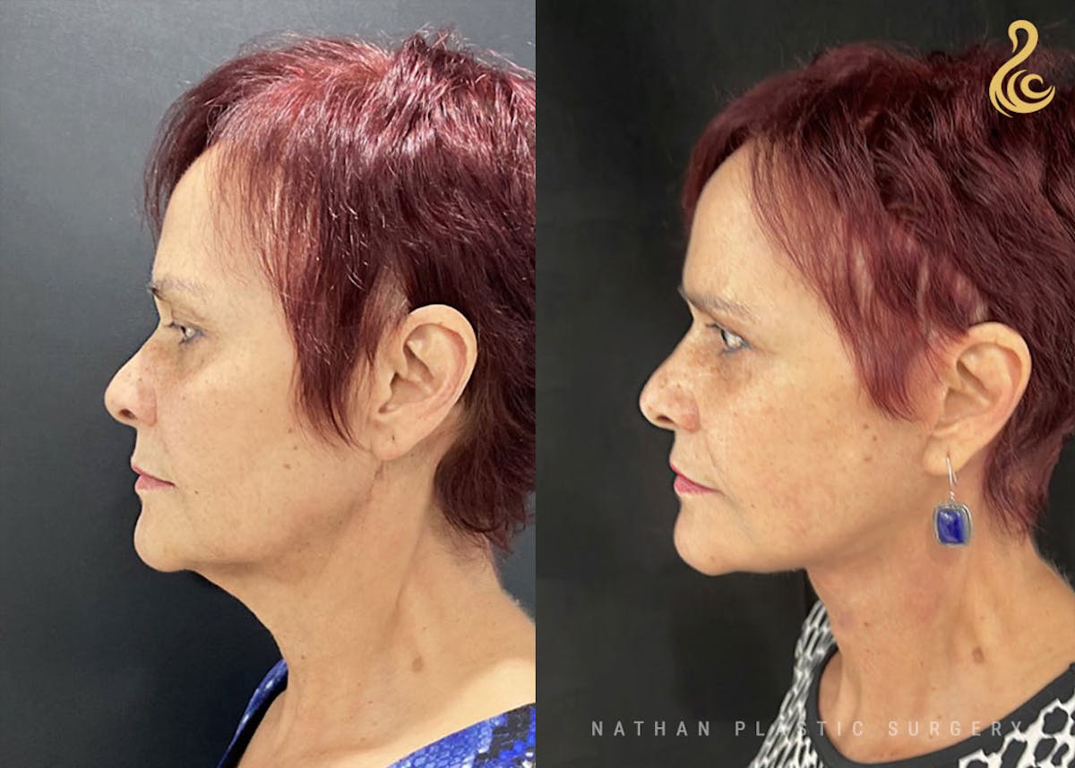 Facelift Before & After Gallery - Patient 726367 - Image 4