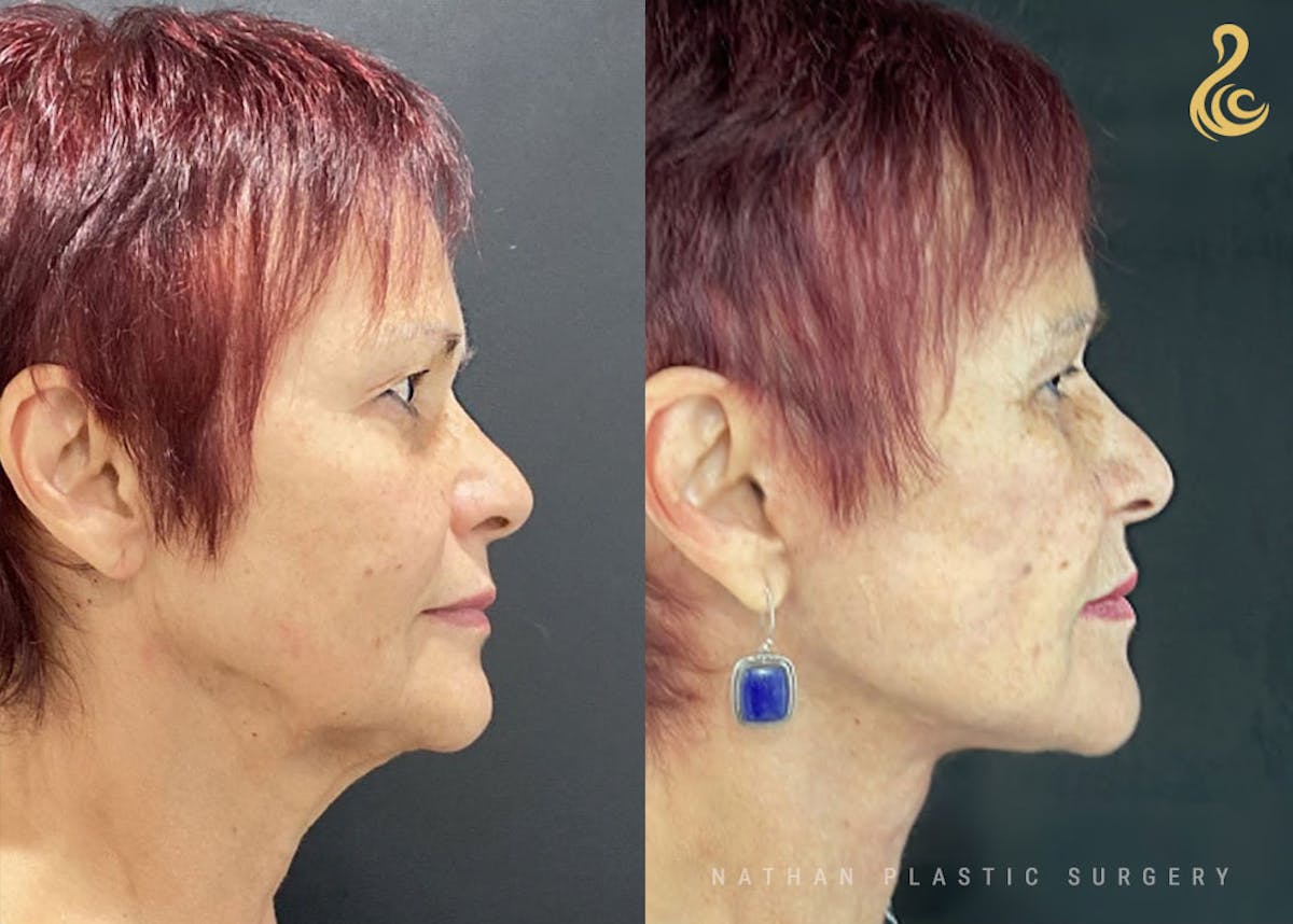 Facelift Before & After Gallery - Patient 726367 - Image 5