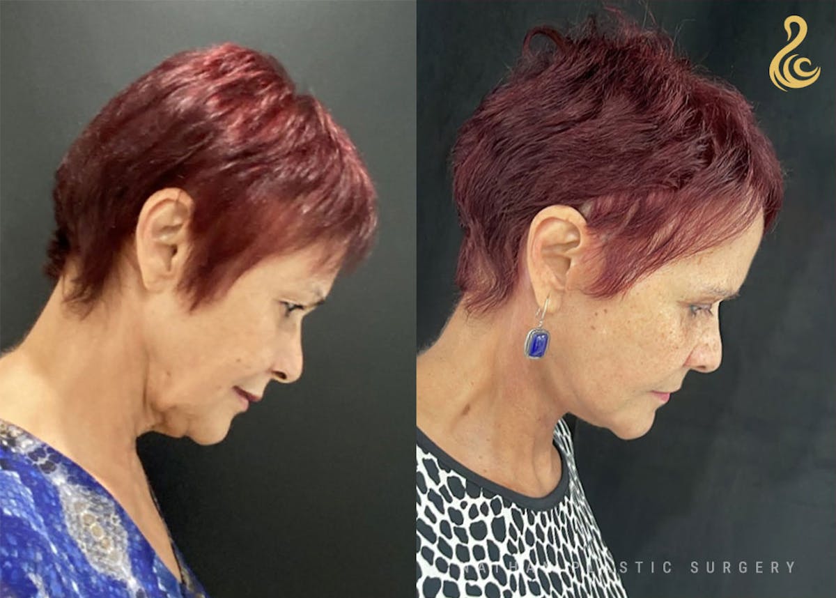 Facelift Before & After Gallery - Patient 726367 - Image 6