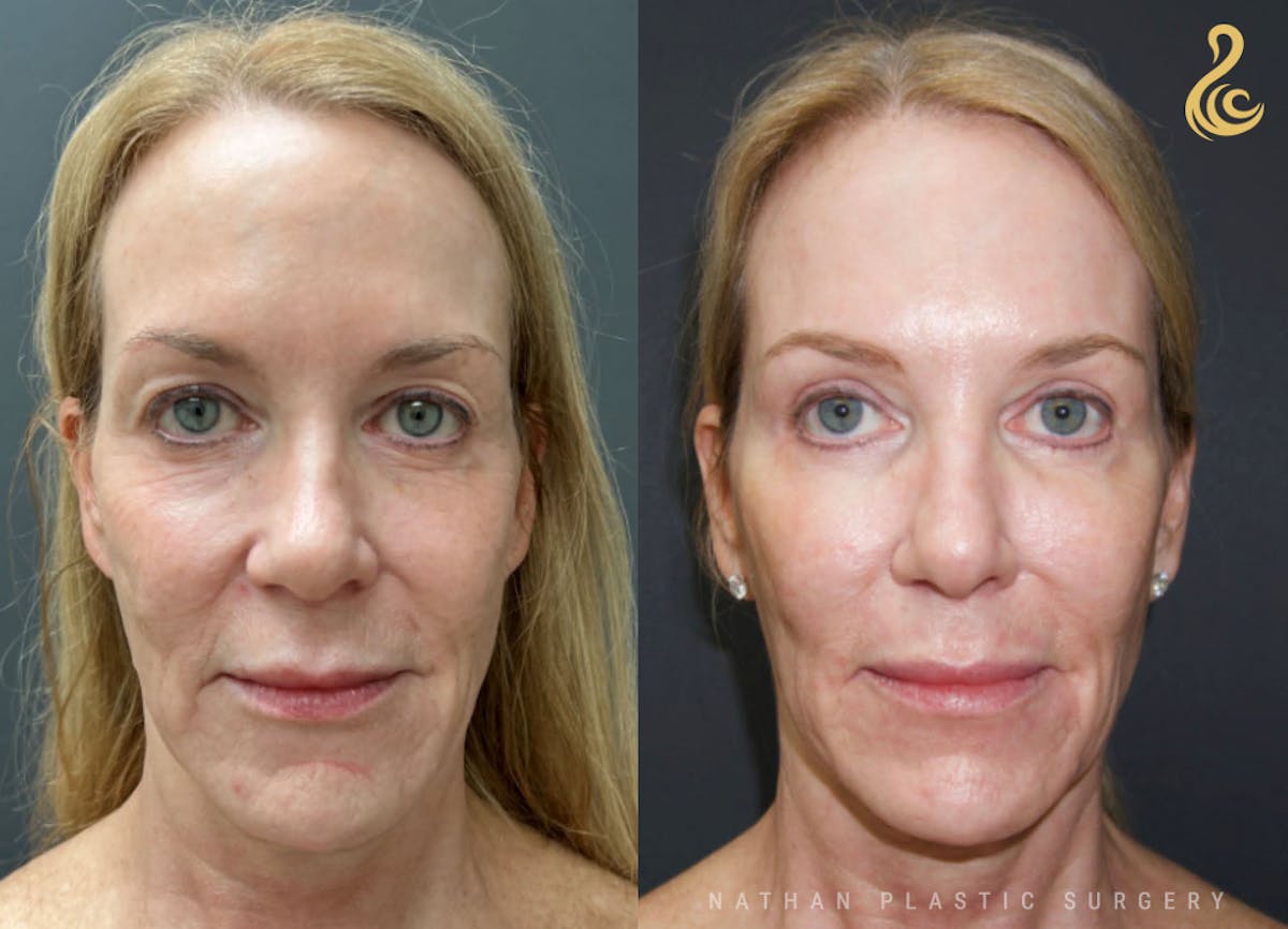 Facial Rejuvenation Before & After Gallery - Patient 404943 - Image 1