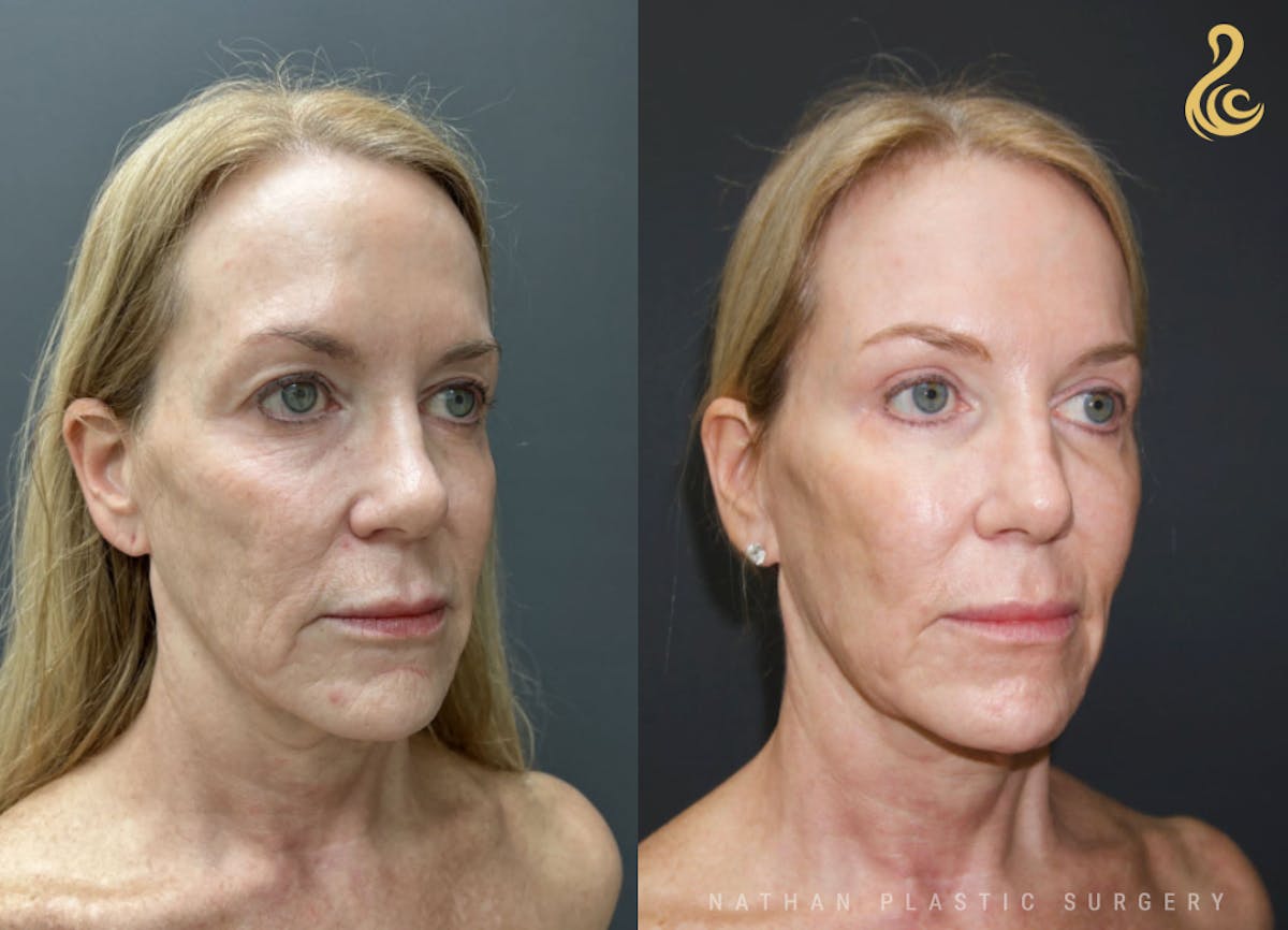 Facial Rejuvenation Before & After Gallery - Patient 404943 - Image 2