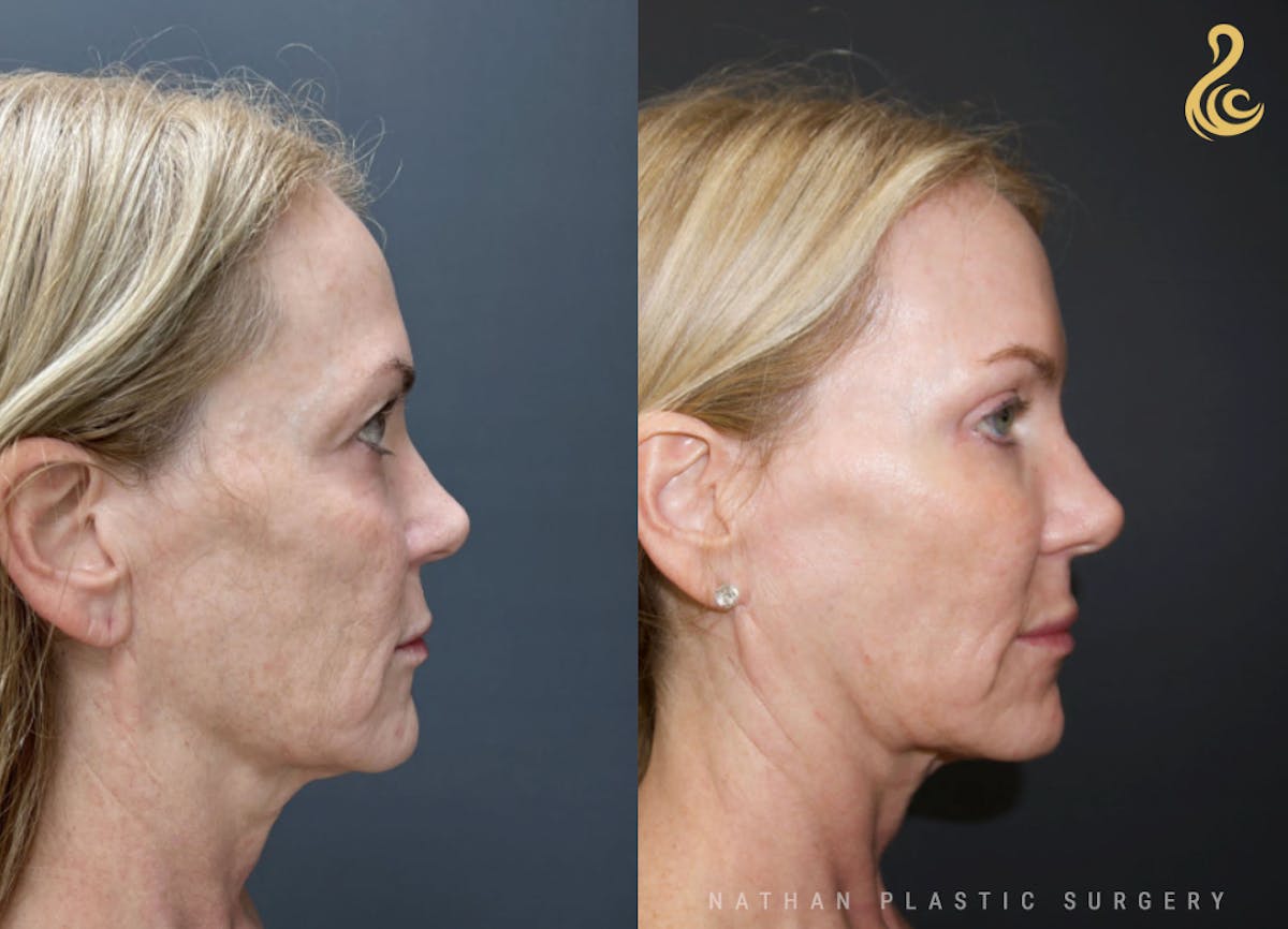 Facial Rejuvenation Before & After Gallery - Patient 404943 - Image 3