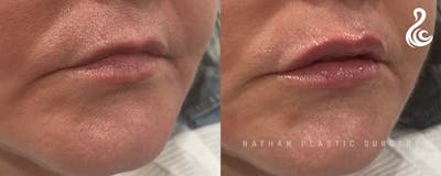 Lip Augmentation Before & After Gallery - Patient 257527 - Image 1