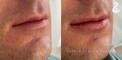 Lip Augmentation Before & After Gallery - Patient 248430 - Image 1