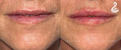 Lip Augmentation Before & After Gallery - Patient 414252 - Image 1