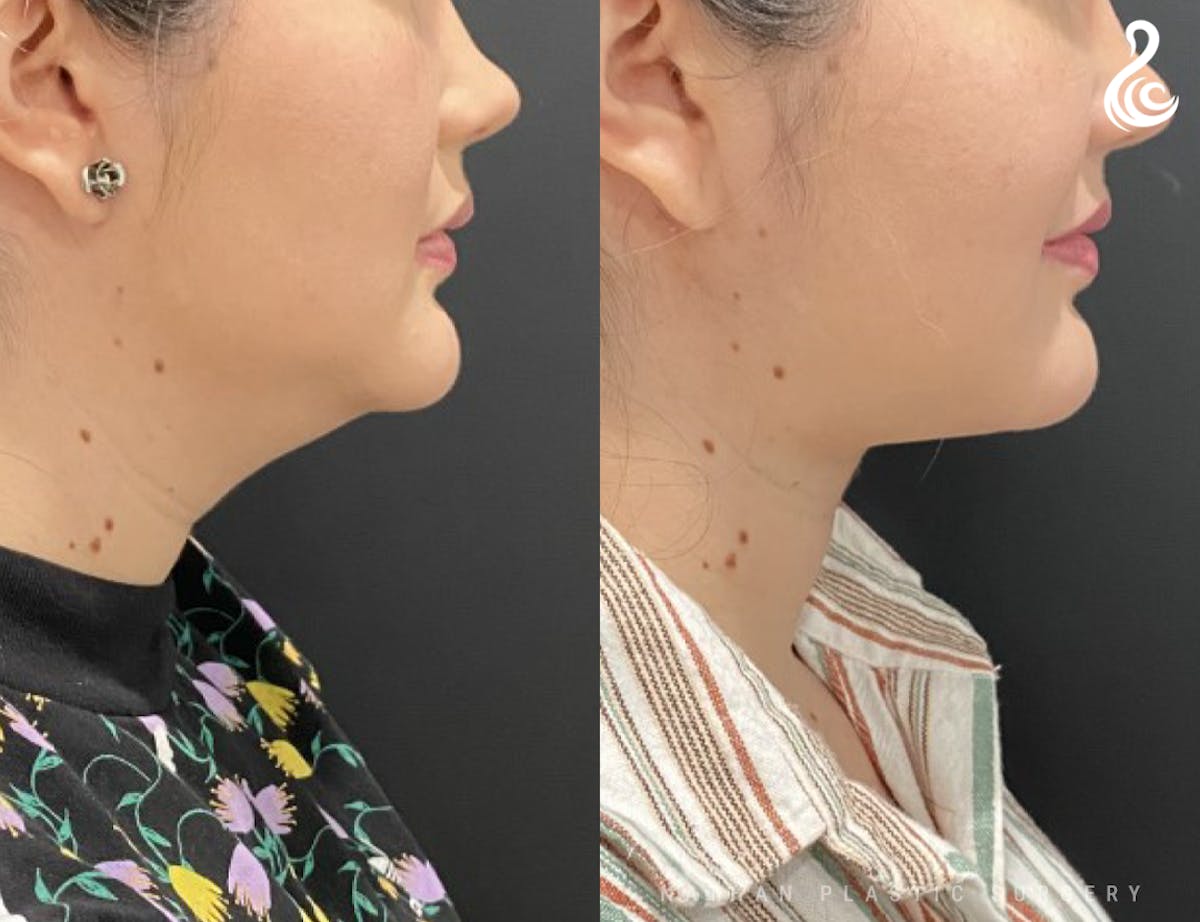 Neck Liposuction Before & After Gallery - Patient 144932 - Image 1