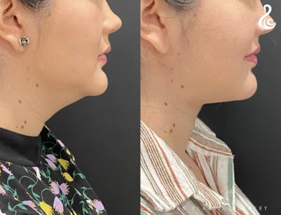Neck Liposuction Before & After Gallery - Patient 144932 - Image 1