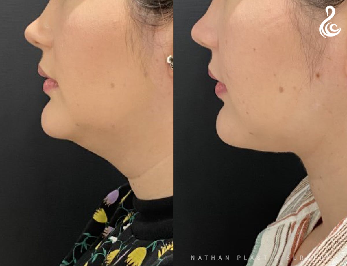 Neck Liposuction Before & After Gallery - Patient 144932 - Image 2