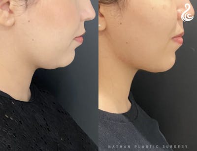 Neck Liposuction Before & After Gallery - Patient 160109 - Image 1
