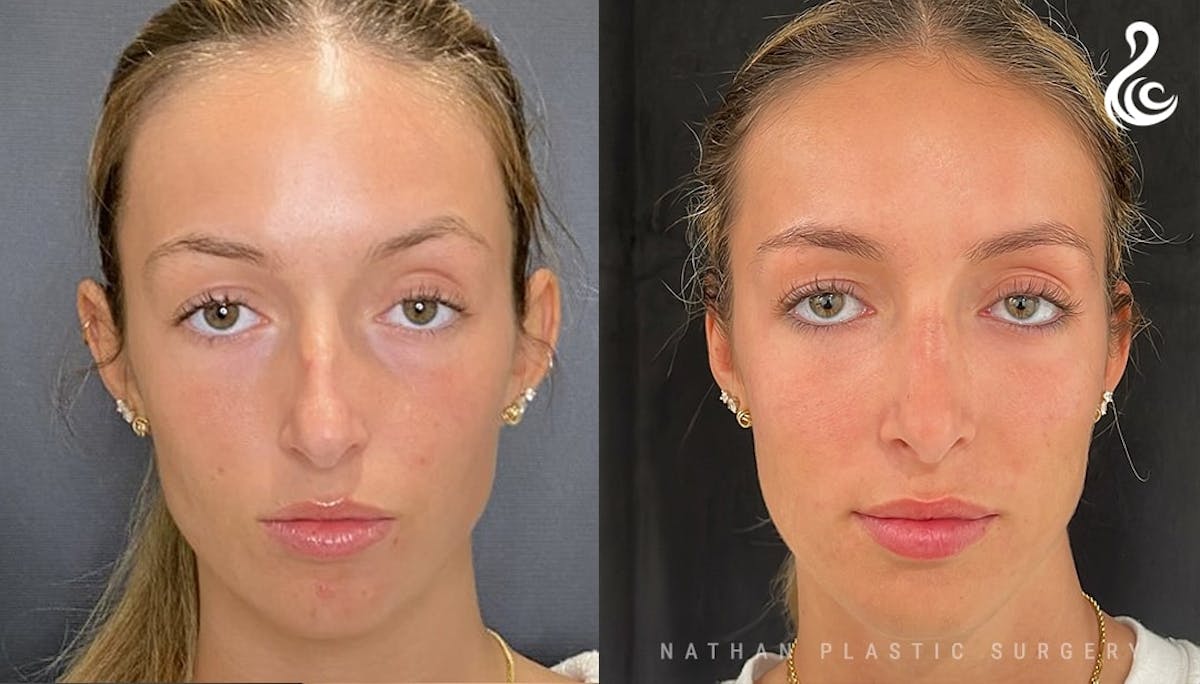 Rhinoplasty Before & After Gallery - Patient 202362 - Image 3
