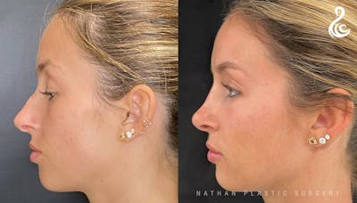 Rhinoplasty Before & After Gallery - Patient 202362 - Image 1