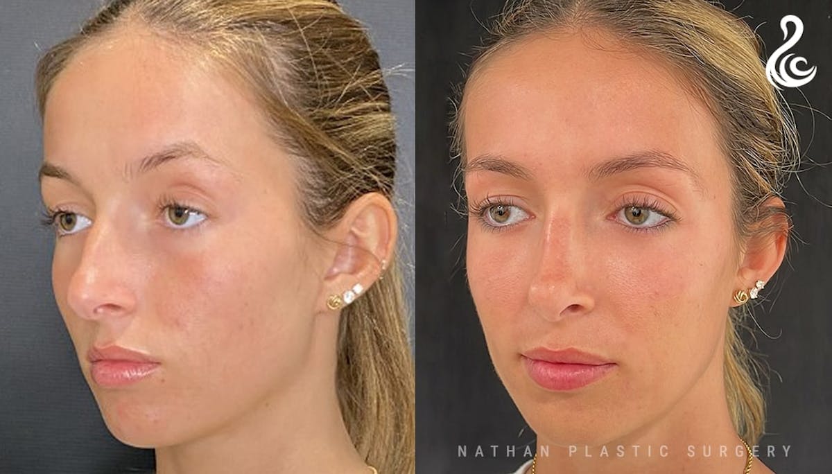 Rhinoplasty Before & After Gallery - Patient 202362 - Image 5