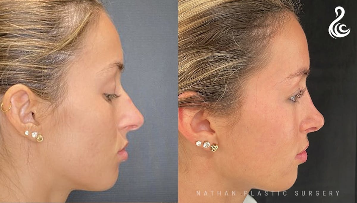 Rhinoplasty Before & After Gallery - Patient 202362 - Image 2