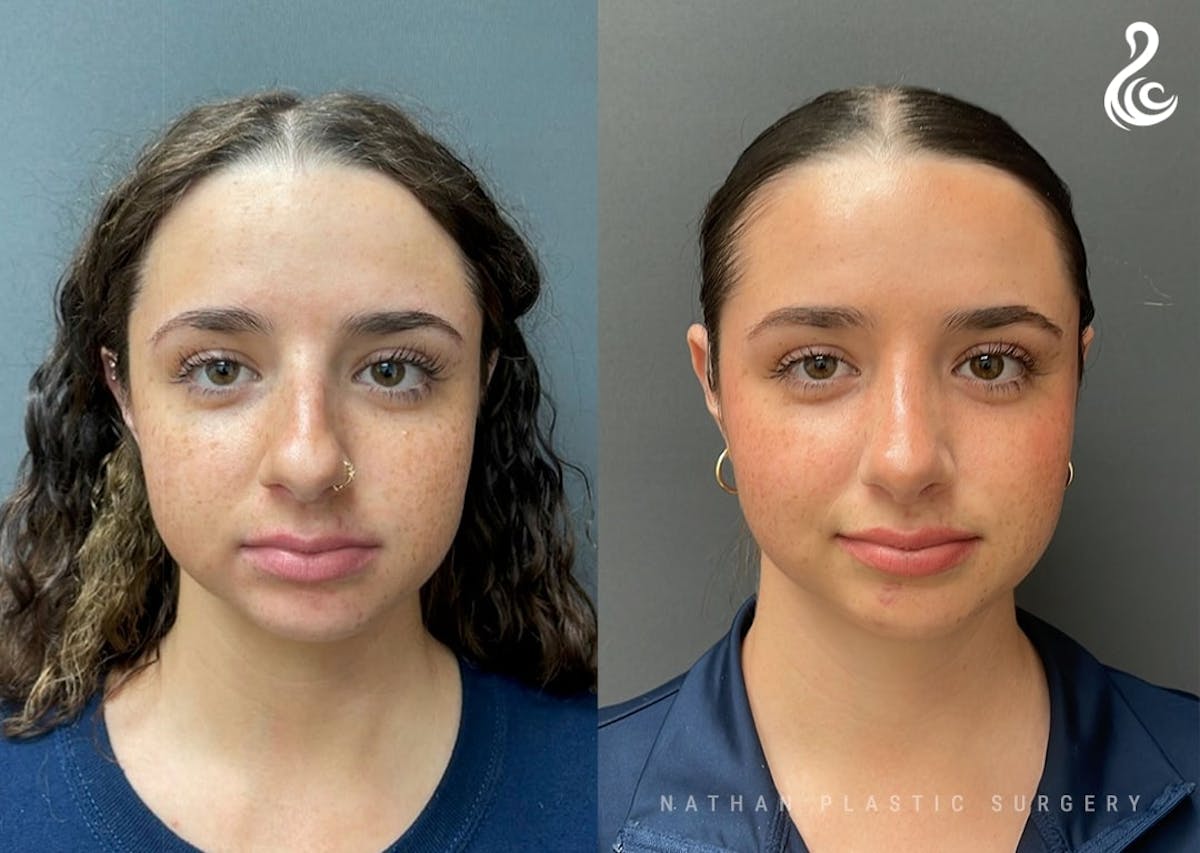 Rhinoplasty Before & After Gallery - Patient 223197 - Image 3