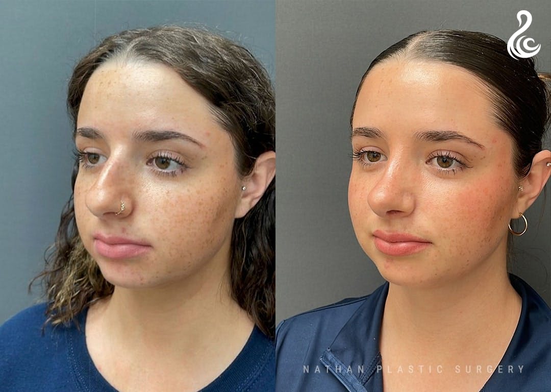 Rhinoplasty Before & After Gallery - Patient 223197 - Image 4