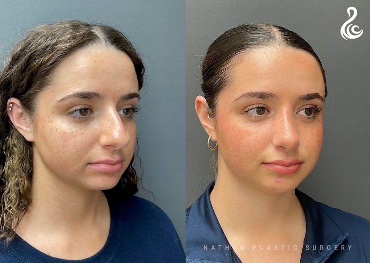 Rhinoplasty Before & After Gallery - Patient 223197 - Image 5