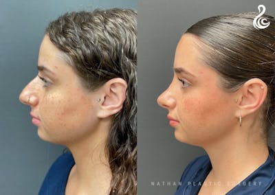 Rhinoplasty Before & After Gallery - Patient 223197 - Image 1
