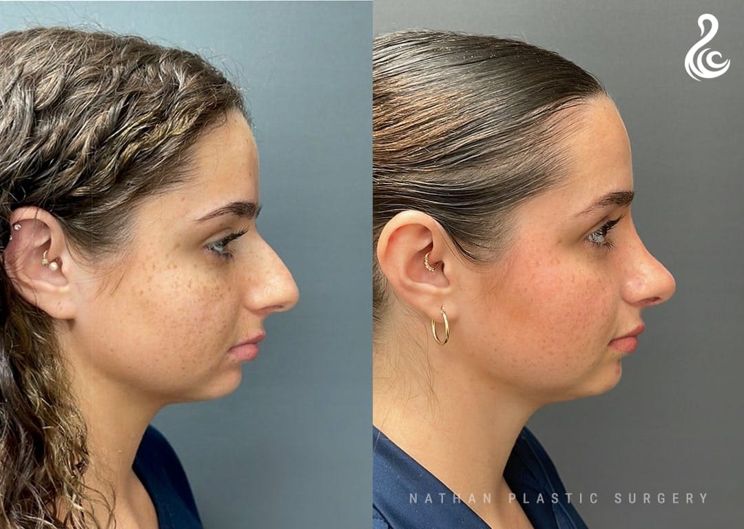 Rhinoplasty Before & After Gallery - Patient 223197 - Image 2