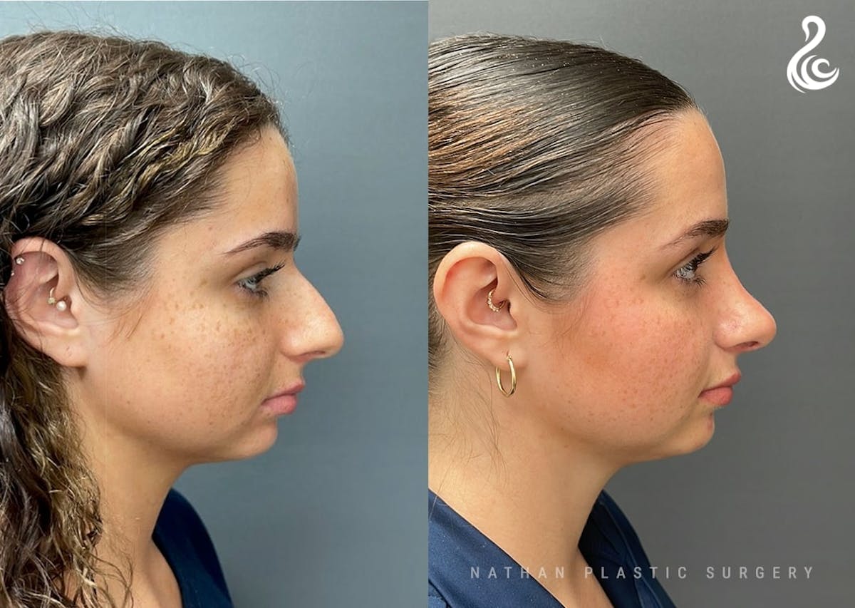 Rhinoplasty Before & After Gallery - Patient 223197 - Image 2